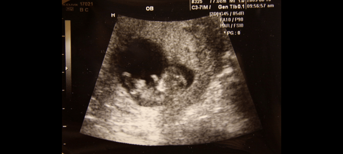 Сколько будет 11 недель. УЗИ ребенка на 11 неделе беременности. Эмбрион на 11 неделе беременности. 11 Недель беременности фото плода на УЗИ. Как выглядит ребенок на УЗИ В 11 недель.